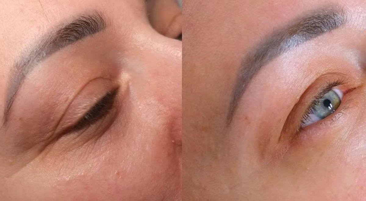 A client's under-eye area before treatment on the left and four weeks later on the right.