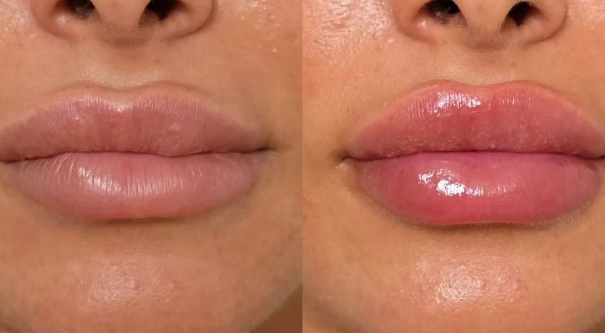 A client's lips before treatment on the left and after on the right.