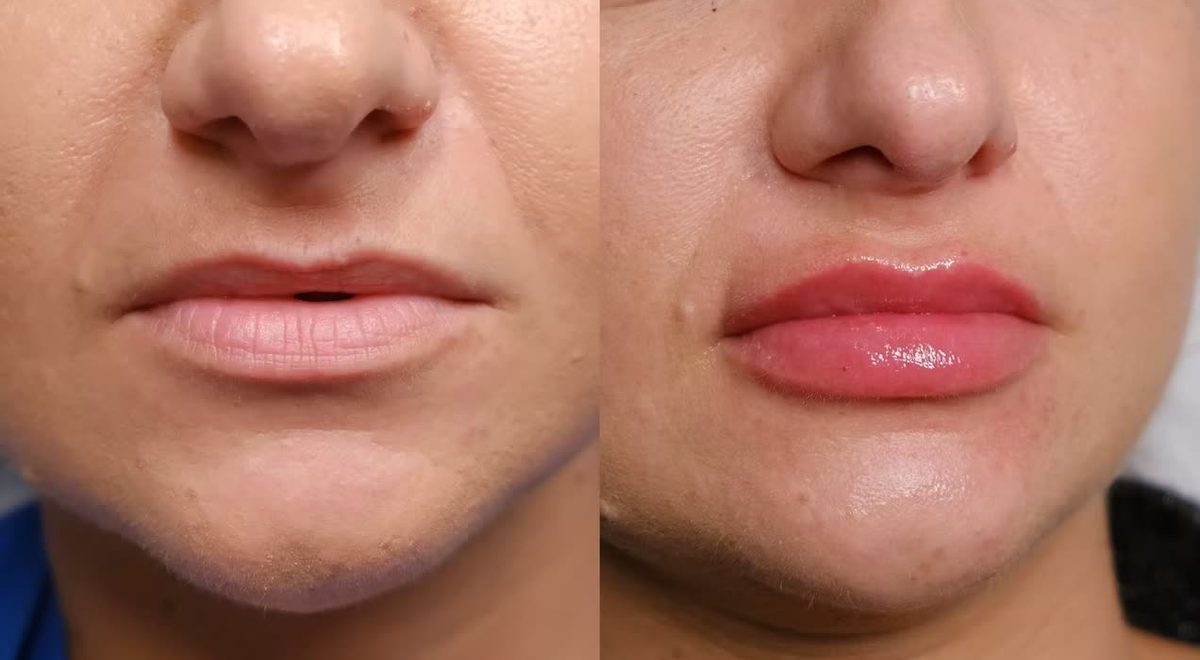 A second client's lips before treatment on the left and after on the right.